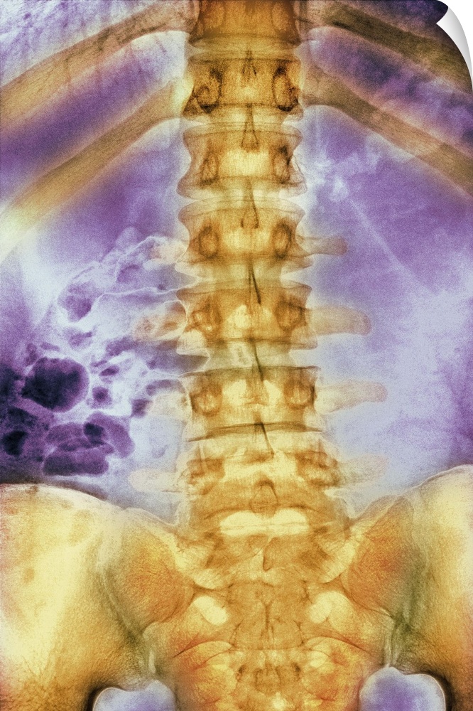 Normal spine. Coloured X-ray of the spine of a 24 year old man.