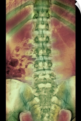 Normal spine, X-ray