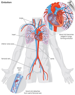Arterial embolism