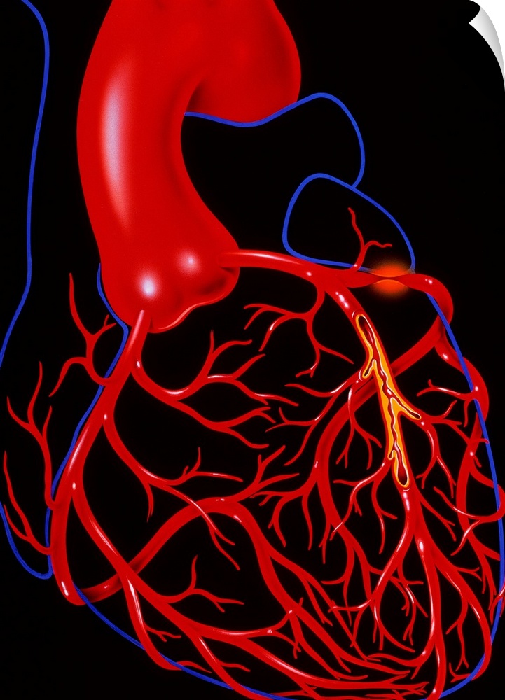 Angina pectoris. Illustration of a heart diseased with the cardiac condition angina pectoris. The heart is outlined in blu...