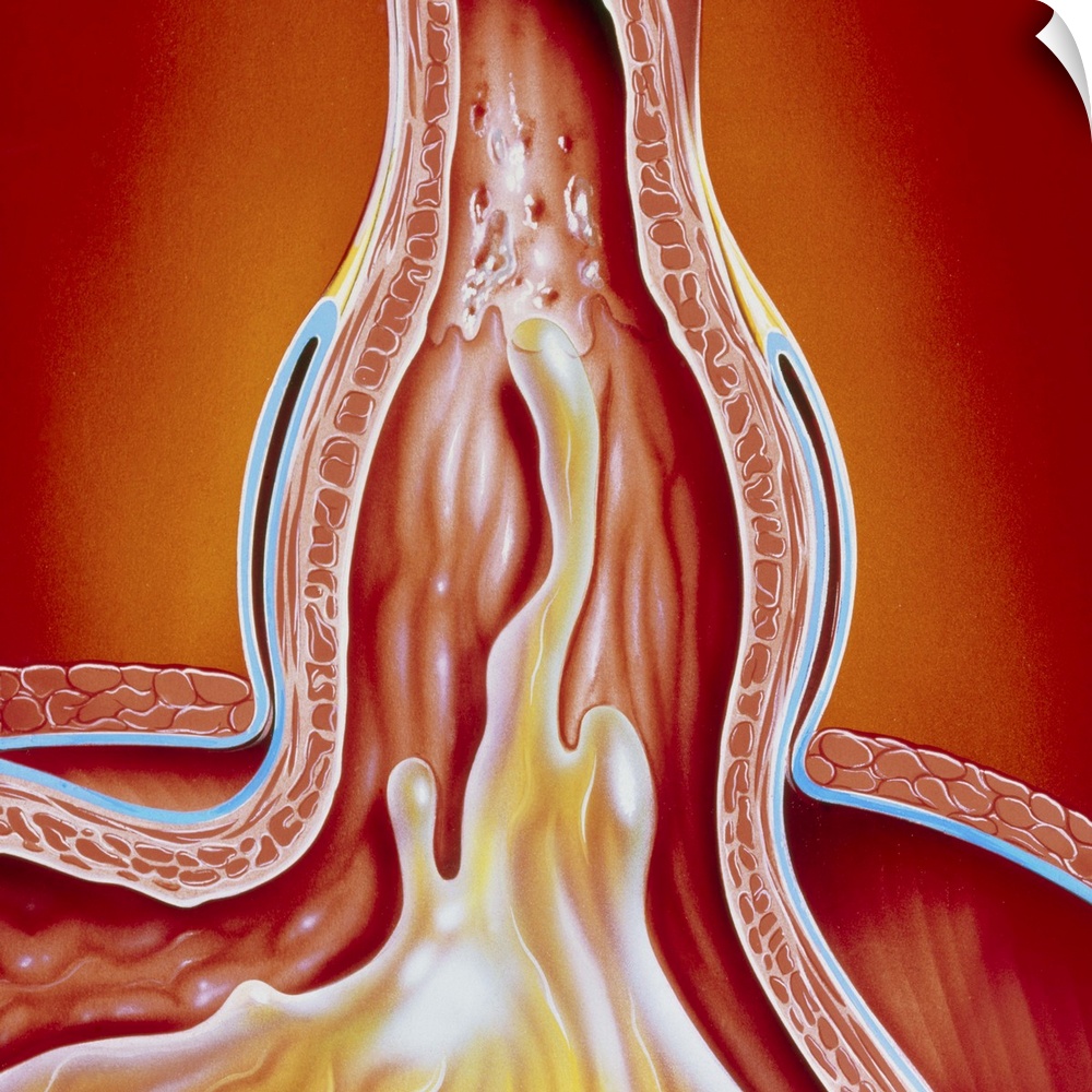 Hiatus hernia. Illustration of a hiatus hernia, showing gastro-oesophageal reflux. Here, the junction between the oesophag...