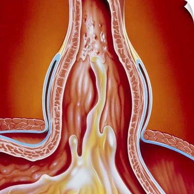 Art of gastro-oesophageal reflux in hiatus hernia