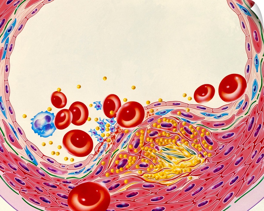 Atherosclerosis. Illustration of a cross-section through an artery narrowed by atherosclerosis. Fat build-up (yellow) has ...