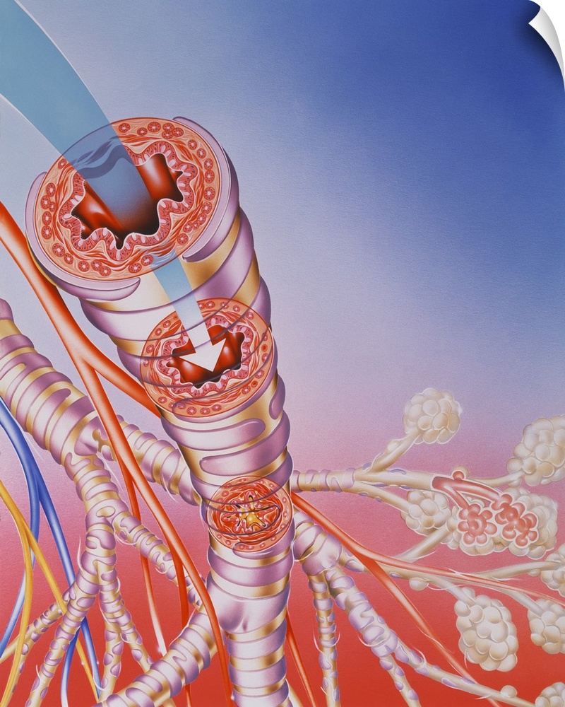 Asthma treatment. Artwork showing the action of a bronchodilator drug breathed into the respiratory system from an aerosol...