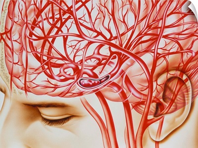 Artwork of cerebral embolism, cause of stroke