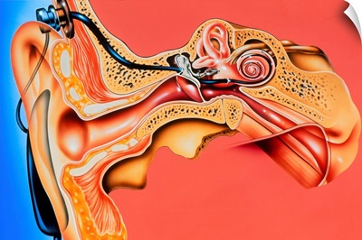 Artwork of cochlear implant in ear