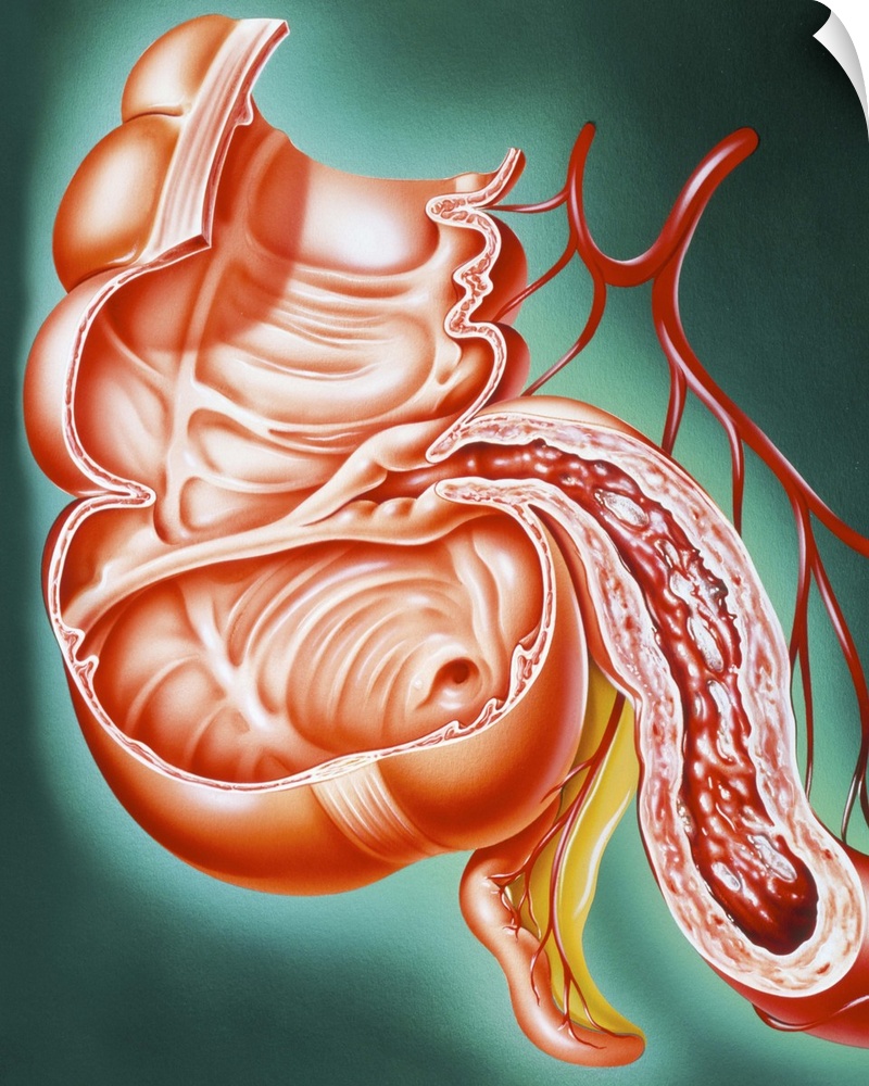 Crohn's disease. Artwork of a section through part of the human digestive tract, showing the small intestine affected by C...