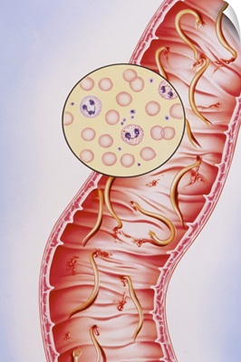 Artwork of intestinal hookworm causing anaemia