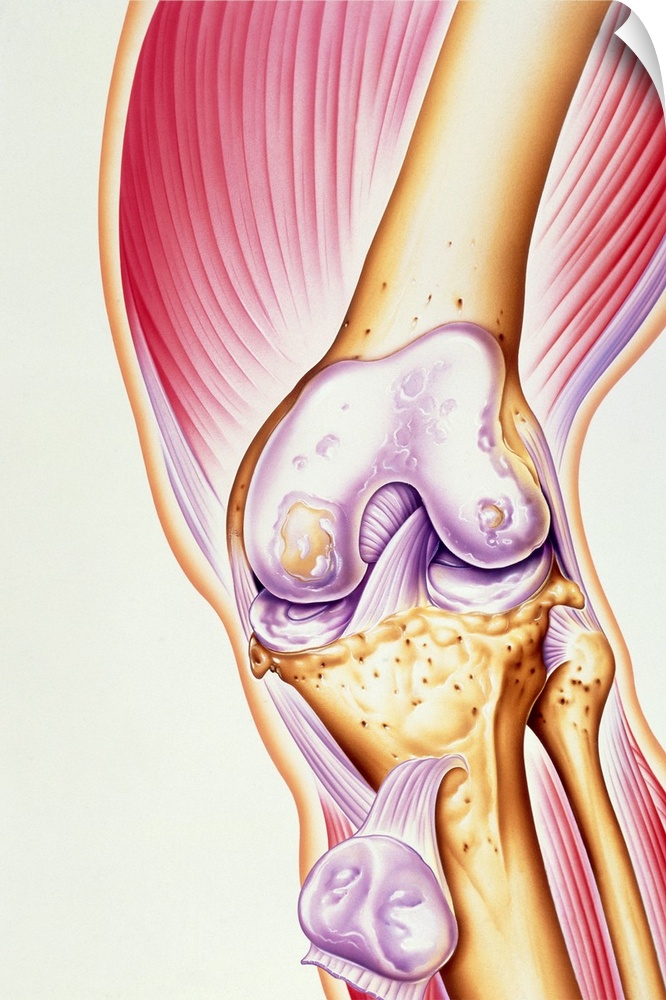 Osteoarthritis of knee. Illustration of the joint of a human knee affected by osteoarthritis. The cartilage (purple) at th...
