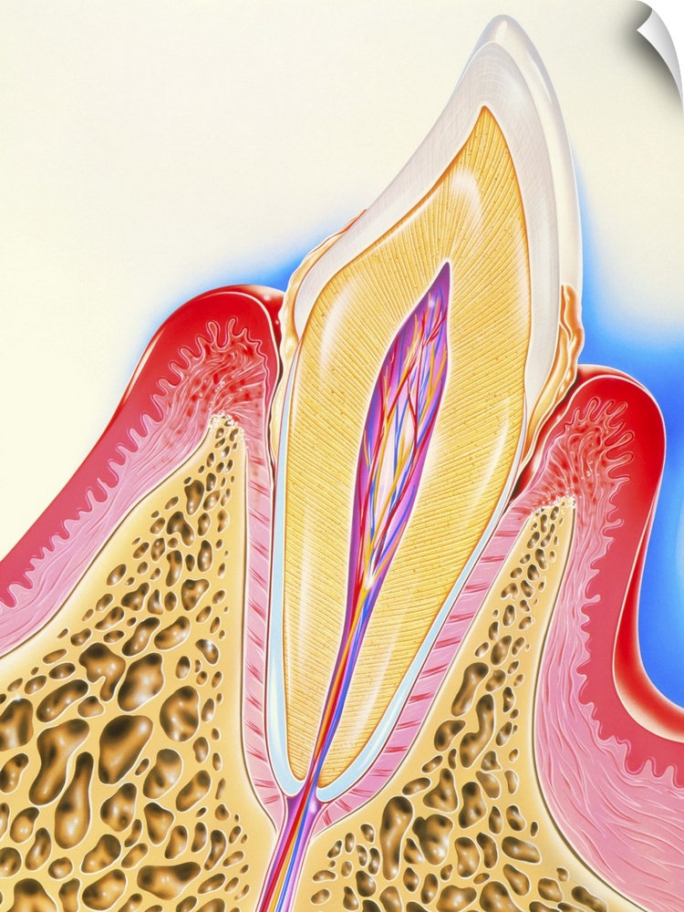 Periodontal disease. Artwork of a section through a human tooth with periodontal disease of its surrounding gum and bone. ...