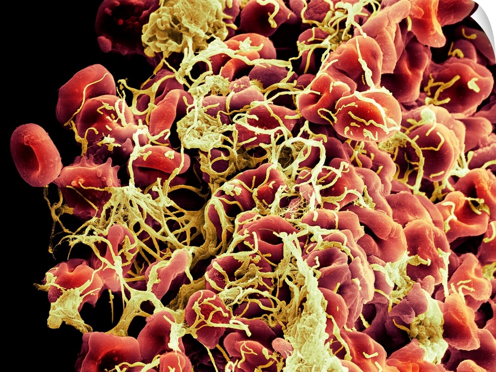 Blood clot. Coloured scanning electron micrograph (SEM) of a blood clot beginning to form. Red blood cells (erythrocytes, ...