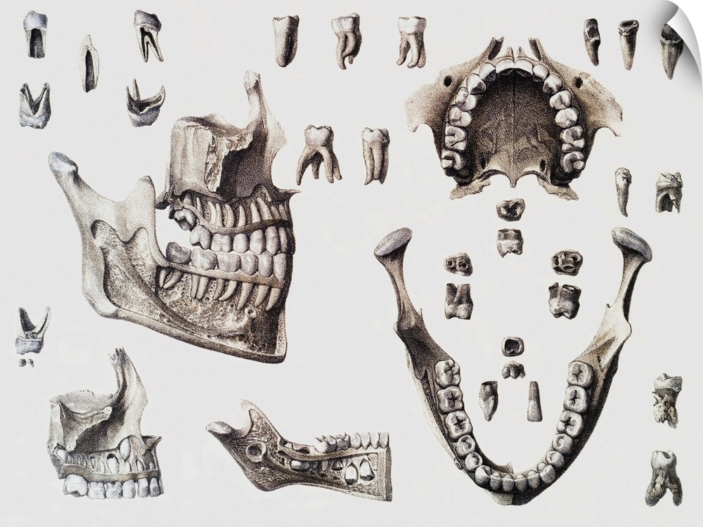 Dental anatomy. Historical anatomical artwork of healthy and diseased human teeth and jaws. The teeth and jaws are seen fr...