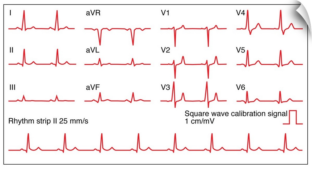 Electrocardiograms (ECG) of a normal heart rate, artwork. An ECG measures the electrical activity of the heart. The wave o...