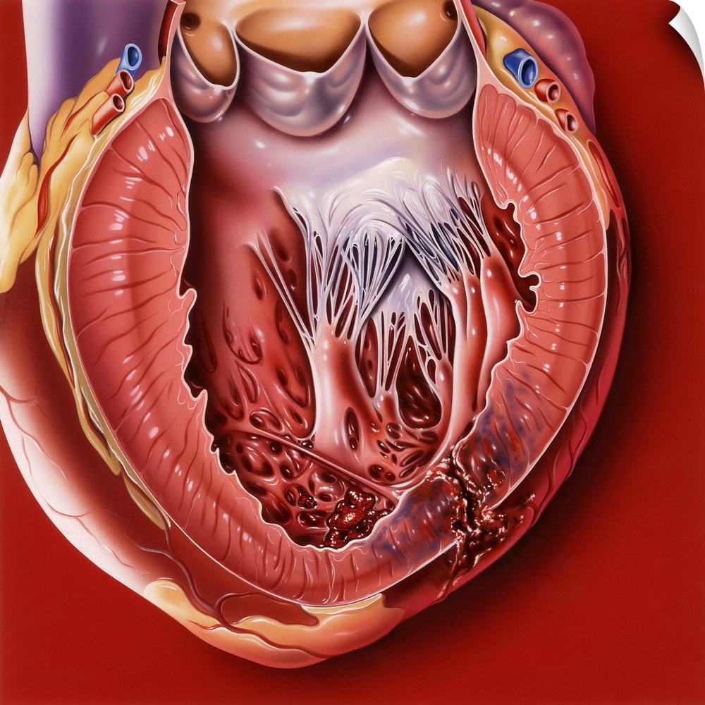 Heart disease. Computer artwork of a sectioned heart showing a myocardial rupture (bottom right) in the left ventricle (lo...