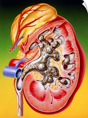 Illustration of a calculus or stone in the kidney
