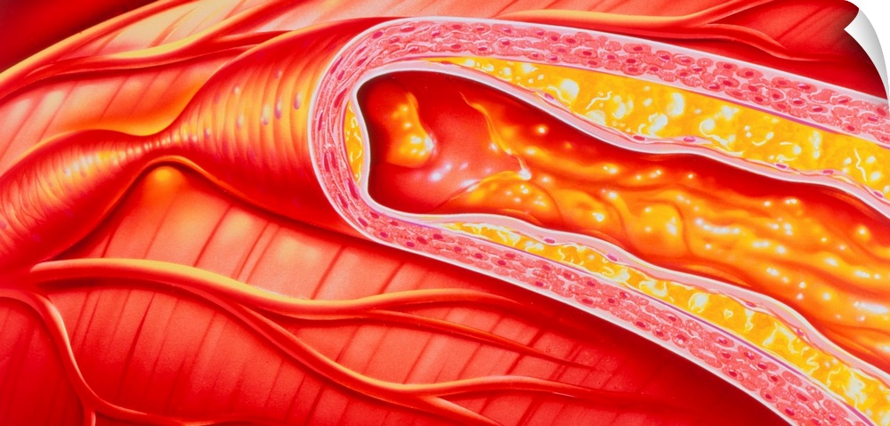 Atherosclerosis. Illustration of branches of a coronary artery on the surface of the heart, in which one branch is disease...