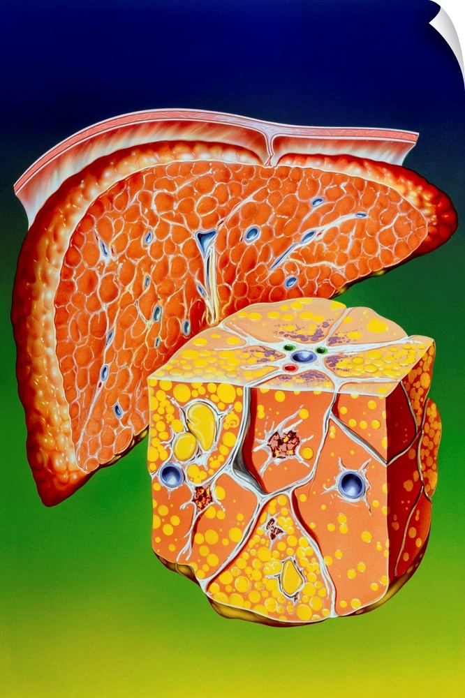 Illustration of septal cirrhosis of the liver. Cirrhosis is a liver disease resulting in chronic damage to liver cells. In...