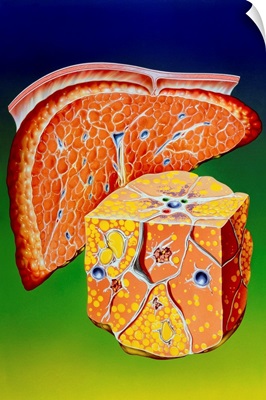 Illustration of septal cirrhosis of the liver