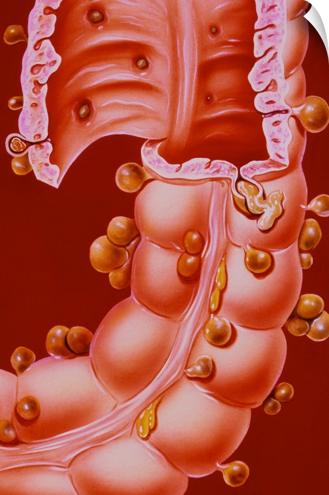 Diverticulitis. Illustration of a region of the descending colon of the human intestine, showing diverticulitis. Also know...