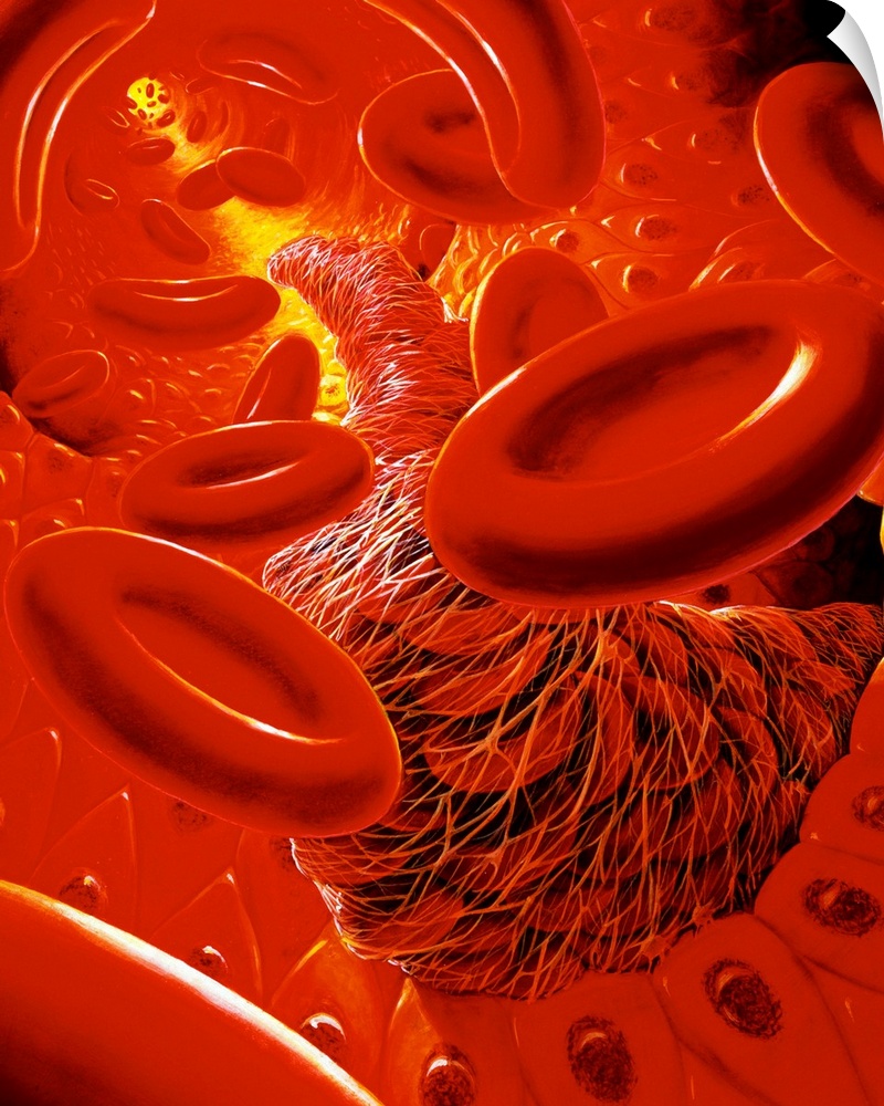 Illustration of the interior of a human blood vessel, showing a snake-like thrombus (blood clot) forming along the length ...
