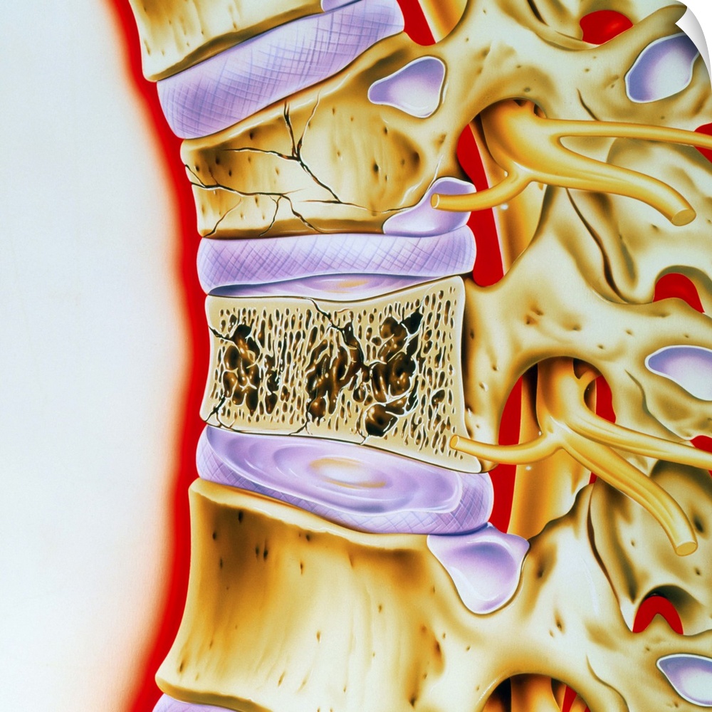 Osteoporosis. Artwork of a spine with fractured vertebrae due to osteoporosis, the loss of protein matrix tissue from the ...