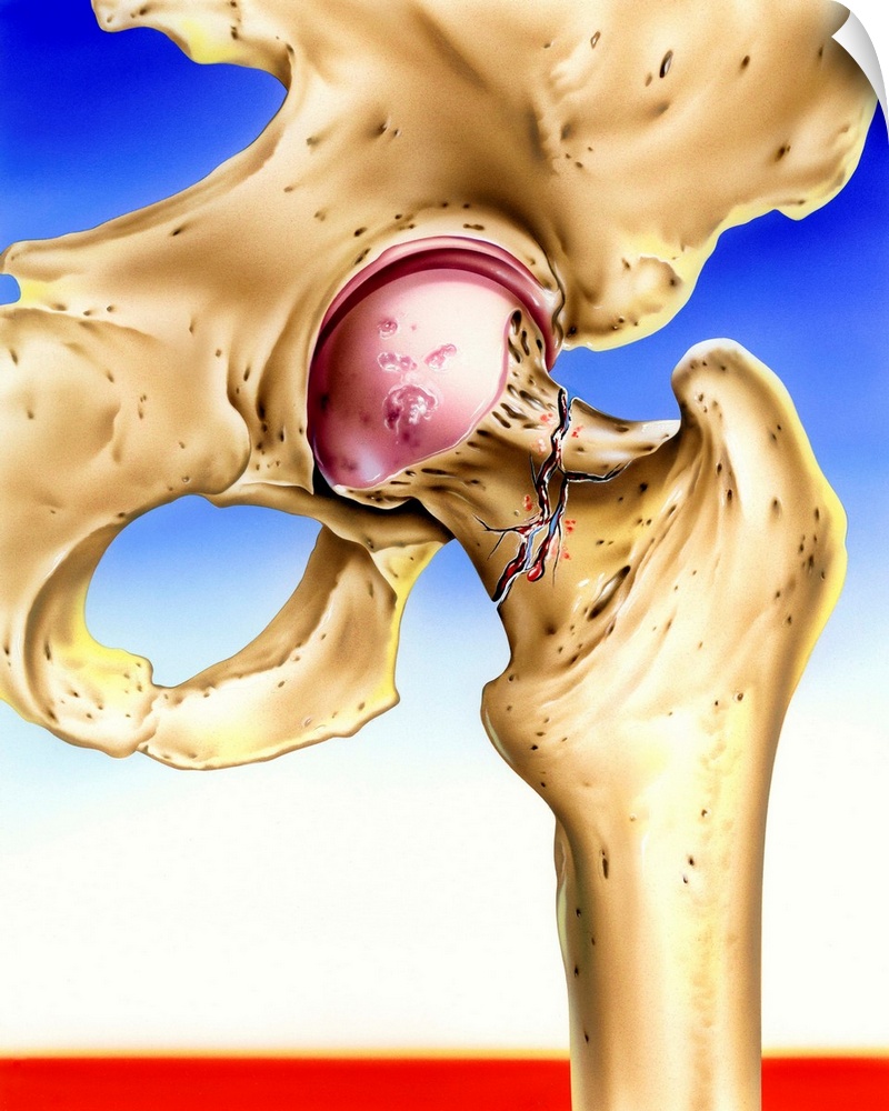 Osteoporosis. Artwork of a hip joint where the neck of the femur (thigh bone) has fractured due to osteoporosis. Osteoporo...