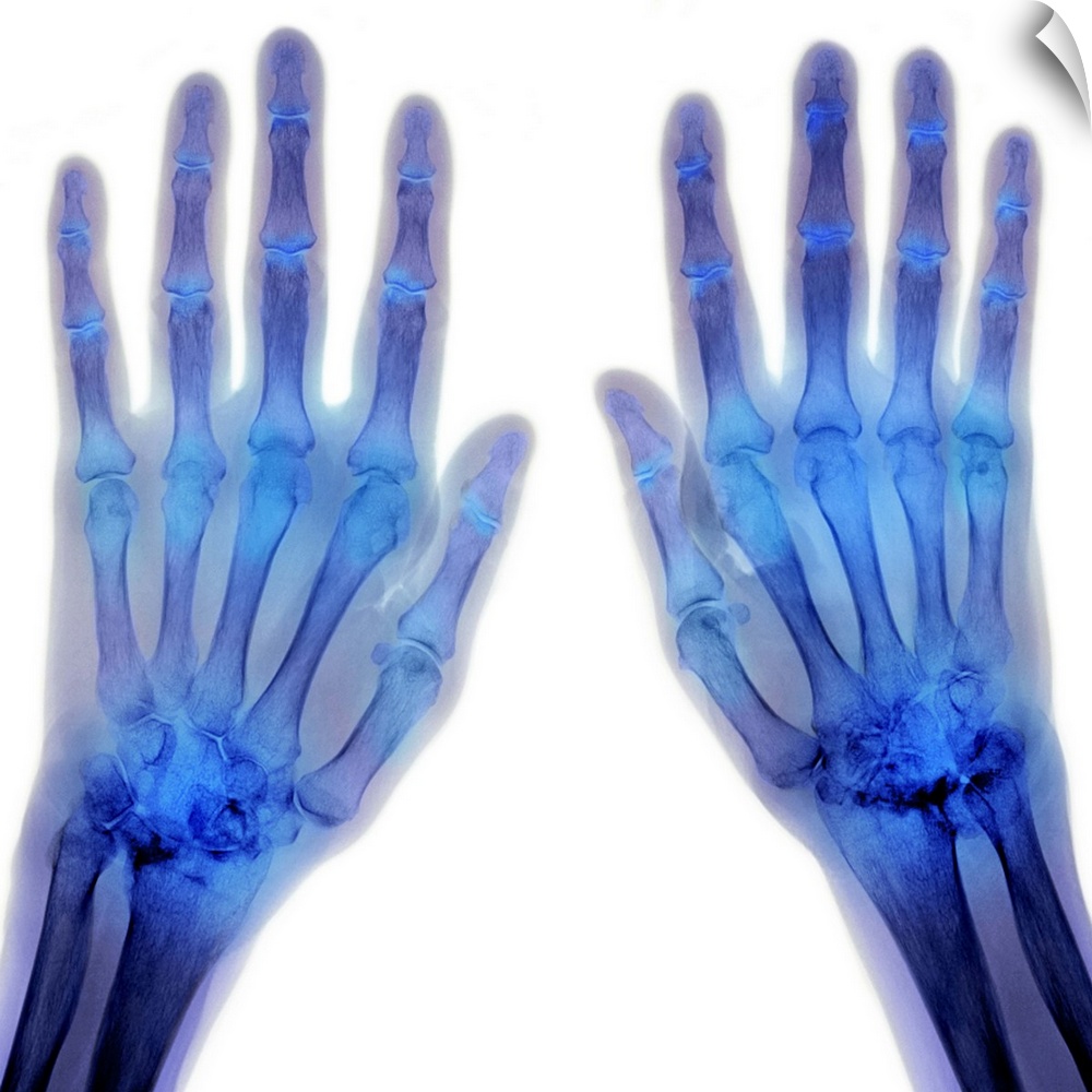 Coloured X-ray (top view) of the hands of a patient, showing rheumatoid arthritis affecting some of the joints at the base...