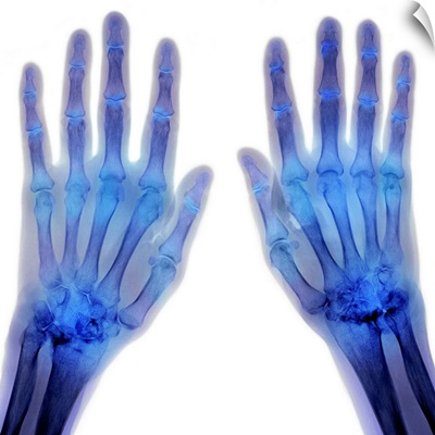 'Rheumatoid arthritis of the hands, X-ray