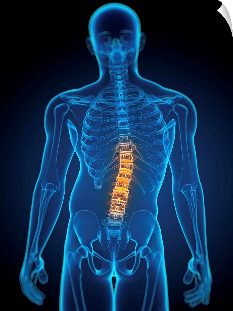 Scoliosis. Computer artwork of a man with a sideways curvature (scoliosis) of the spine.