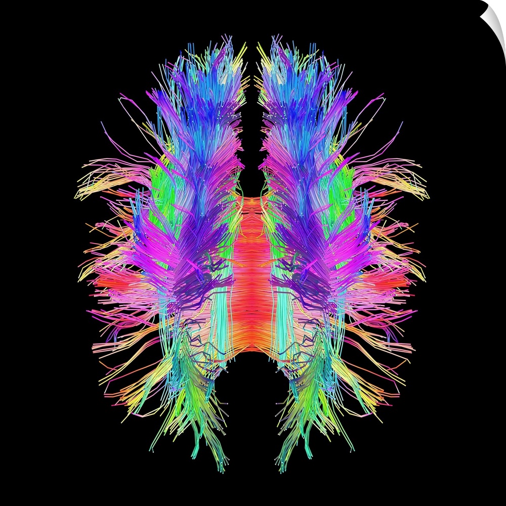 White matter fibres overlaid a 3d model of the human brain in top view. Coloured 3D diffusion spectral imaging (DSI) scan ...