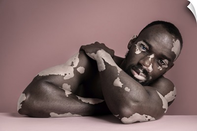 Fashion Portrait Of Black Man With Vitiligo