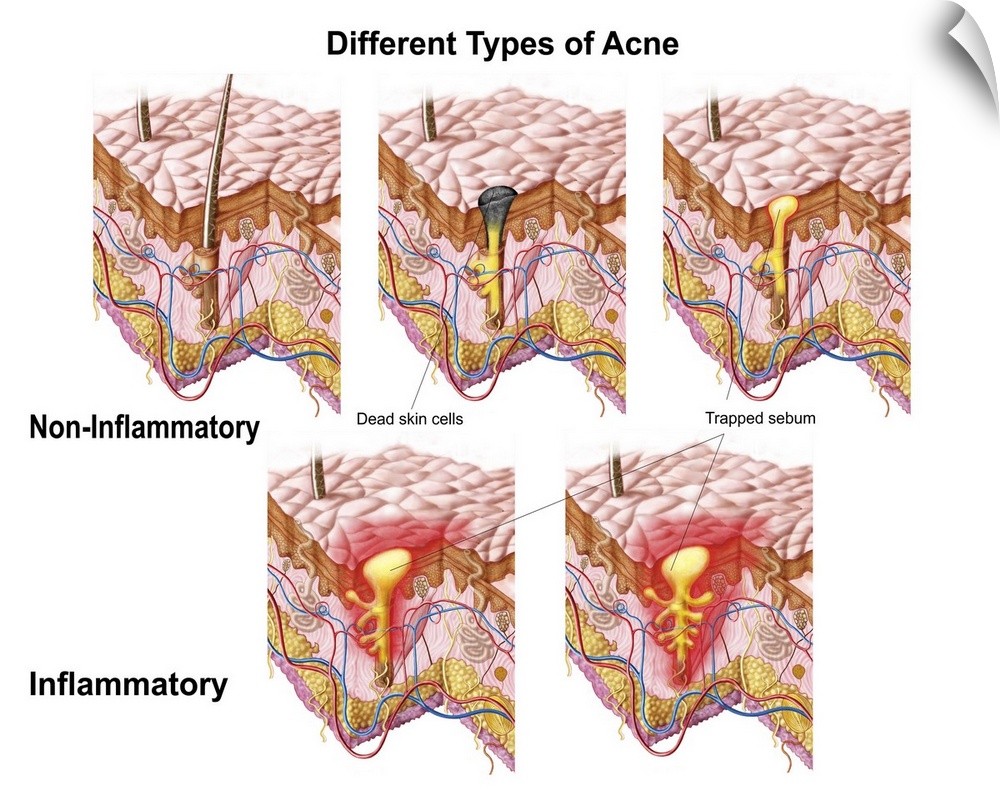 Different types of acne, non-inflammatory and inflammatory.