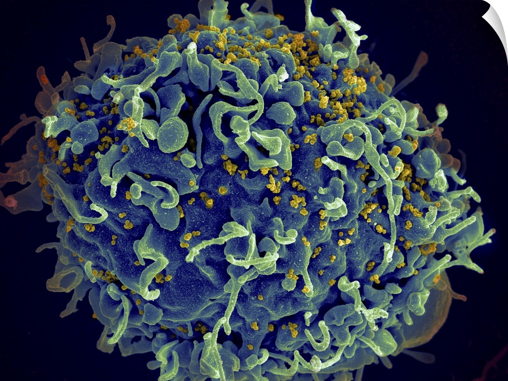 Scanning electron micrograph of HIV particles infecting a human H9 T cell.