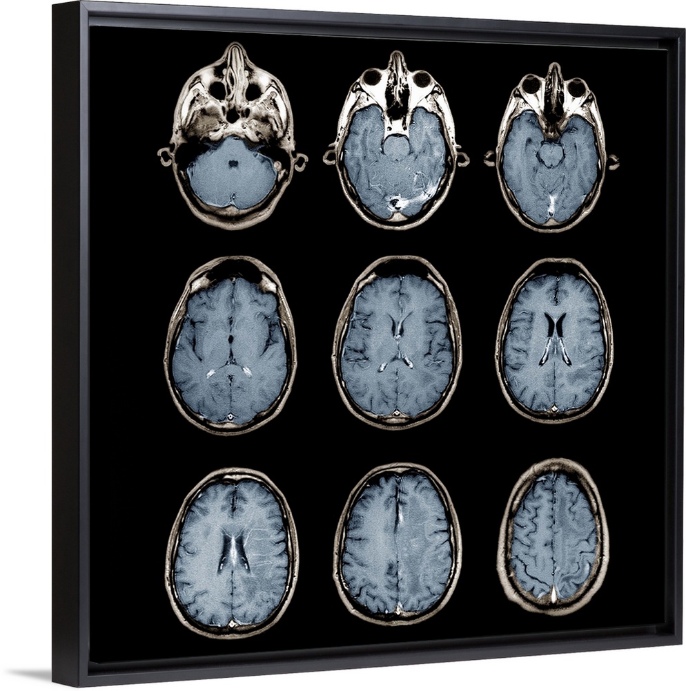 Normal brain. Coloured magnetic resonance imaging (MRI) scans of axial sections through the healthy brain of a 28 year old...