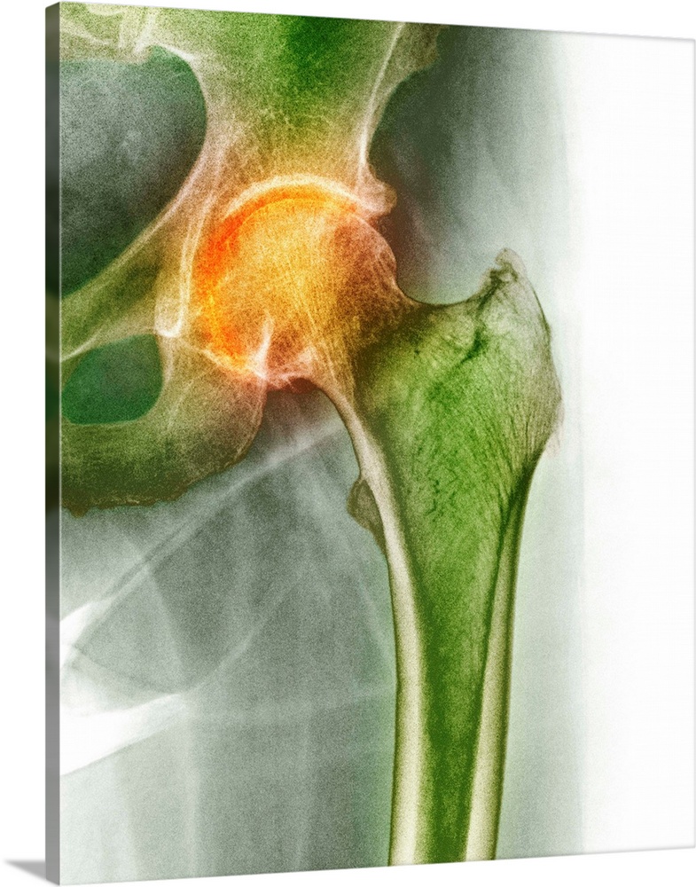 Arthritis of the hip. Coloured X-ray of an arthritic hip.