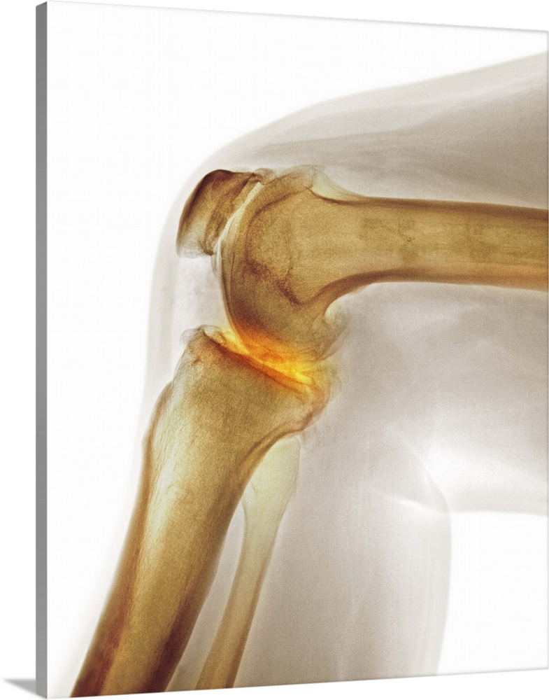 Arthritis of the knee. Coloured X-ray the arthritic knee of a 37 year old man. The knee had previously been damaged in a m...