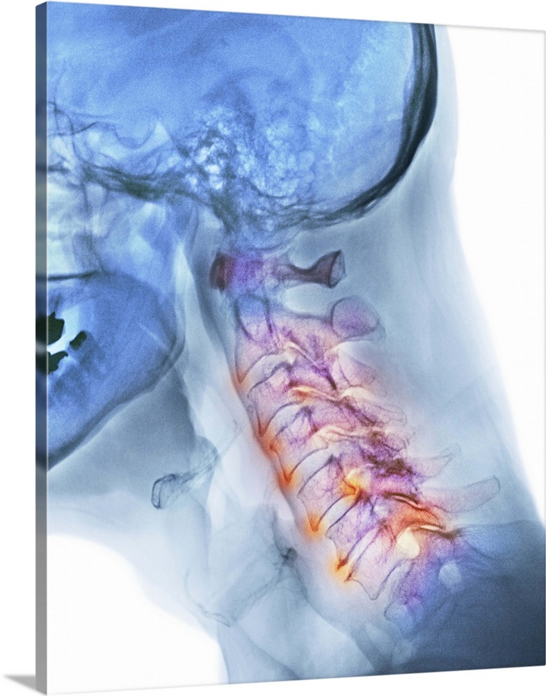 Arthritis of the neck, Xray Wall Art, Canvas Prints, Framed Prints