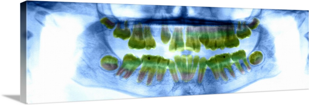 Dental X-ray showing the teeth of a 13 year old girl.