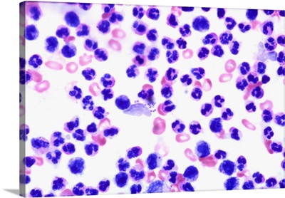 Fluid aspirate from staph infection