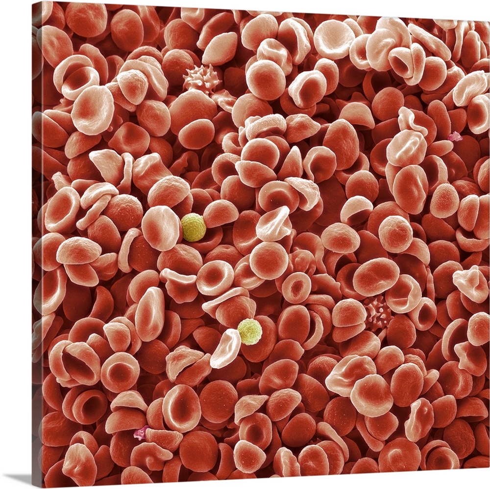 Human blood cells. Coloured scanning electron micrograph (SEM) of normal human blood. The majority of the cells are red bl...