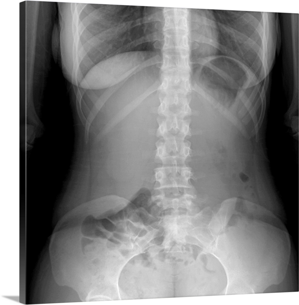 Normal abdomen. X-ray of the abdomen of a 20 year old female.