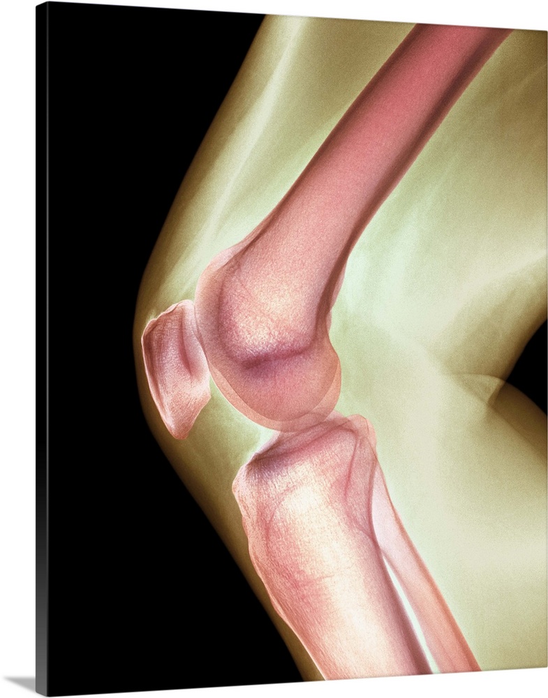 Normal knee. Coloured X-ray of the knee of a 44 year old woman.