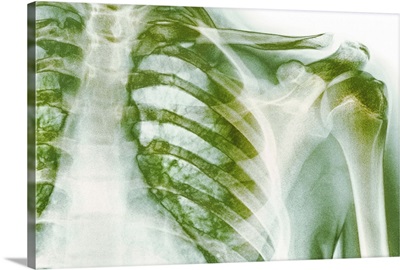 Normal shoulder, X-ray