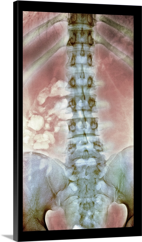 Normal spine. Coloured X-ray of the spine of a 24 year old man.
