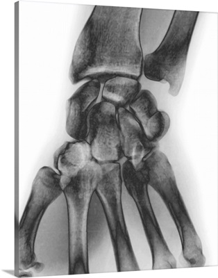 Normal wrist, X-ray.