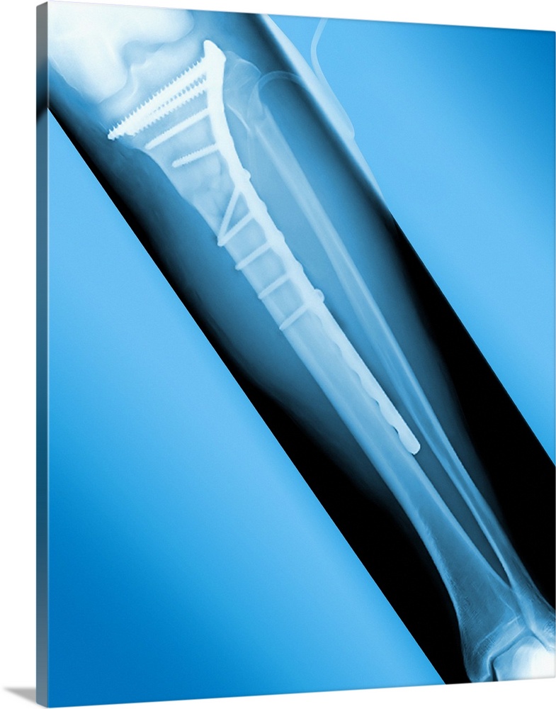 Pinned broken leg. Coloured X-ray of a metal plate and screws in a fractured tibia (shin bone).