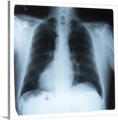 X-ray of a chest cavity