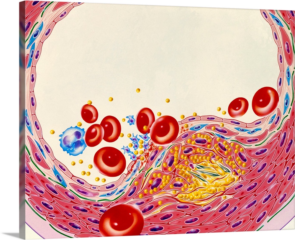 Atherosclerosis. Illustration of a cross-section through an artery narrowed by atherosclerosis. Fat build-up (yellow) has ...