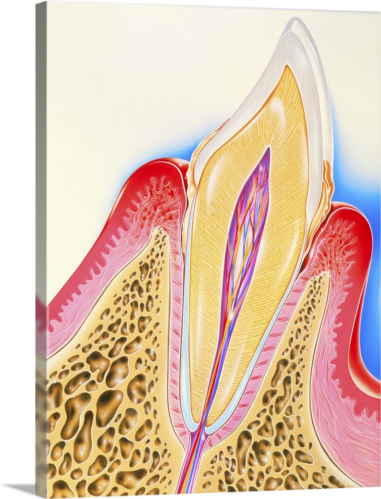 Periodontal disease. Artwork of a section through a human tooth with periodontal disease of its surrounding gum and bone. ...