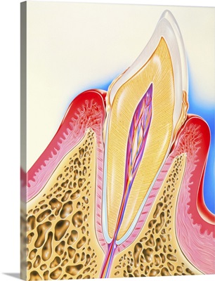 Artwork of tooth showing periodontal disease
